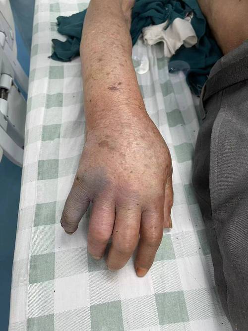 新澳门开奖结果记录历史和被蛇咬两年仍后遗症与被蛇咬了几年后身体有毒素吗